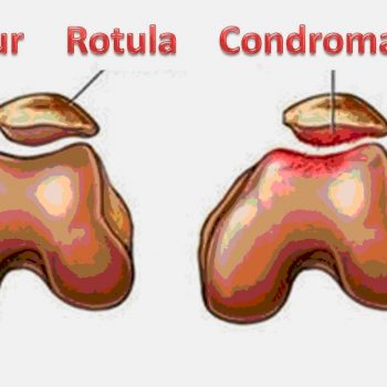 Condropatia Rotuliana