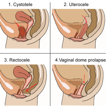 PROLAPSOS VAGINALES